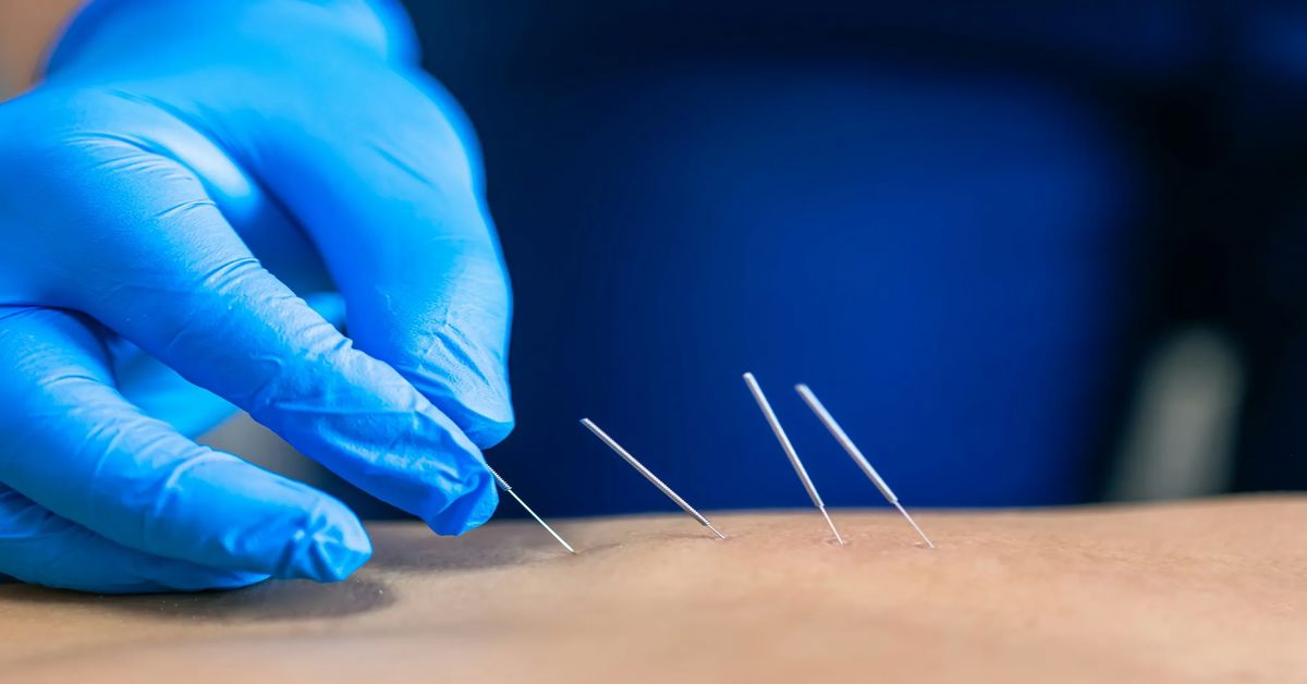 What is Dry Needling Treatment