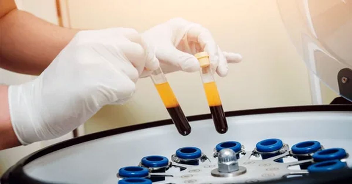 Platelet Rich Plasma Treatment