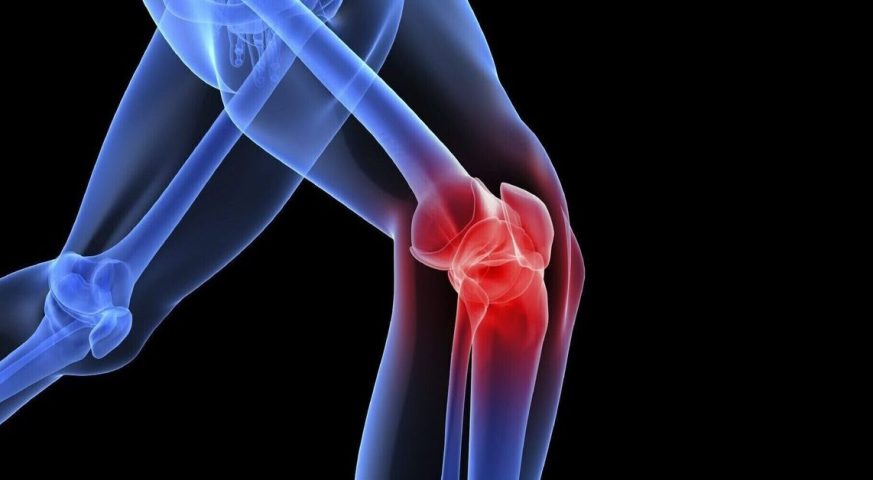 Diz Kireçlenmesi Tedavisi