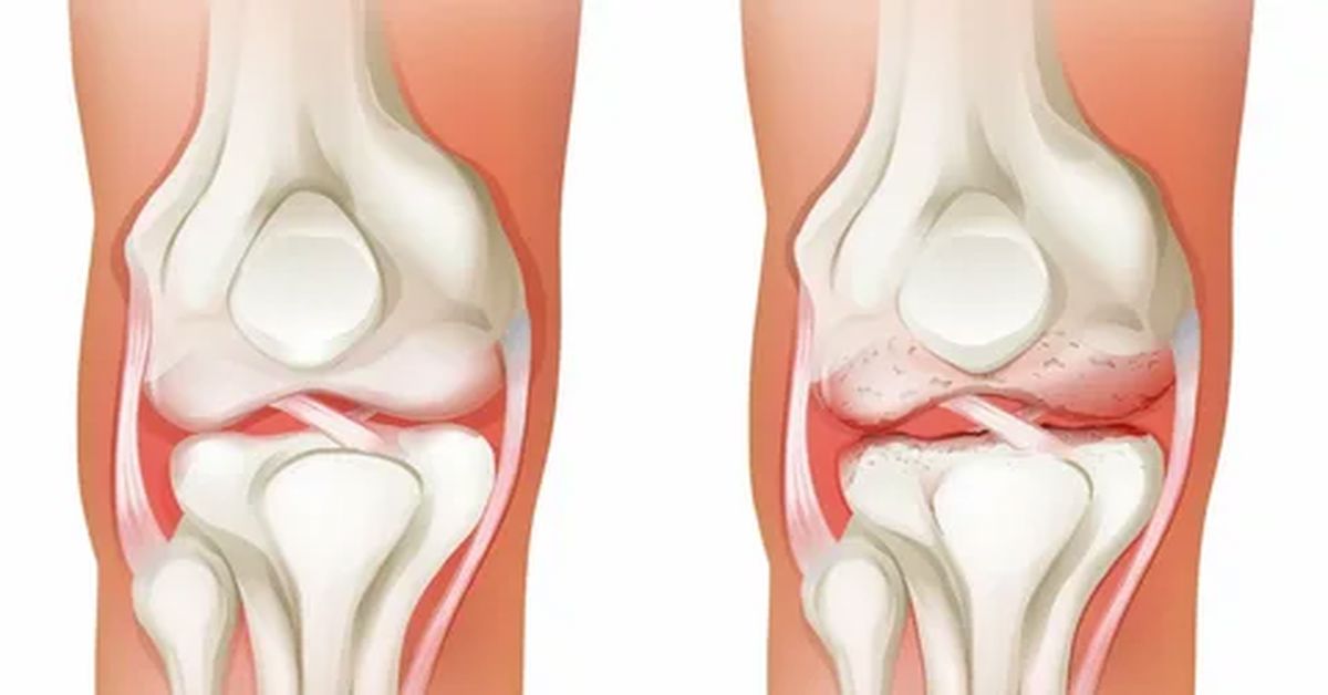 Diz Kireçlenmesi Tedavisi