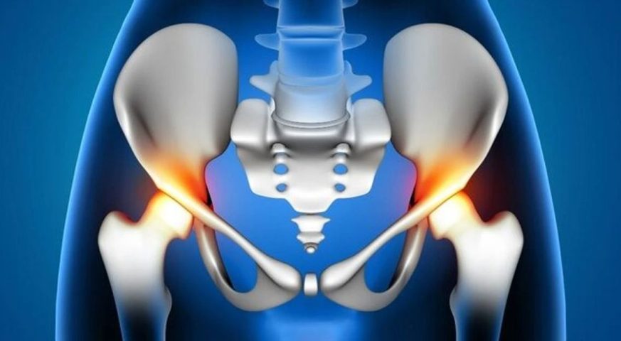 Kalça Kireçlenmesi Tedavisi