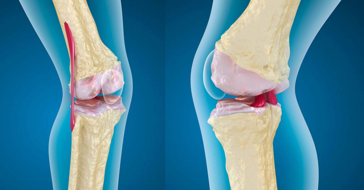 Diz Kireçlenmesi Neden Olur?