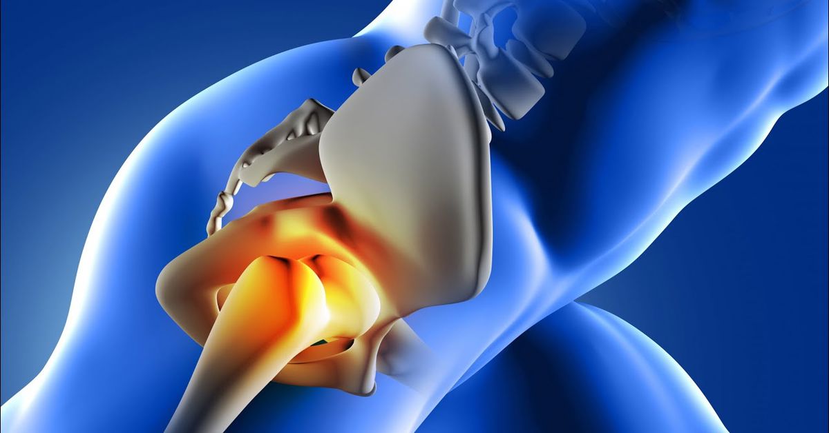 Kalça Kireçlenmesi Belirtileri