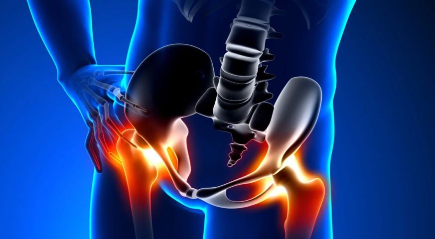 Kalça Kireçlenmesi Belirtileri