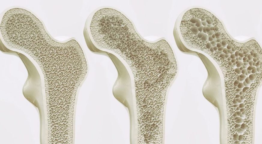 Osteoporosis Treatment