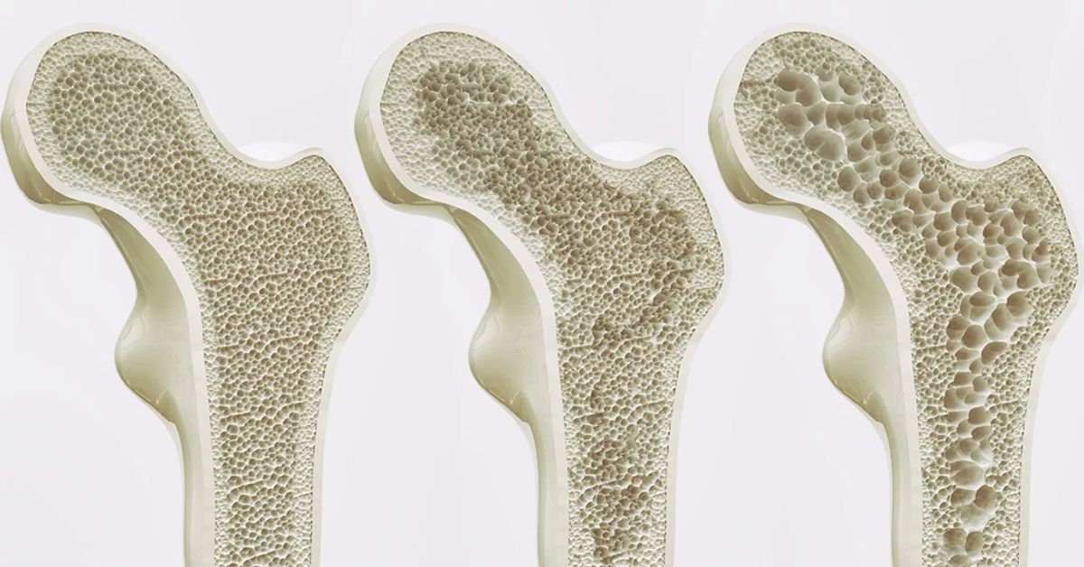 Kemik Erimesi Belirtileri