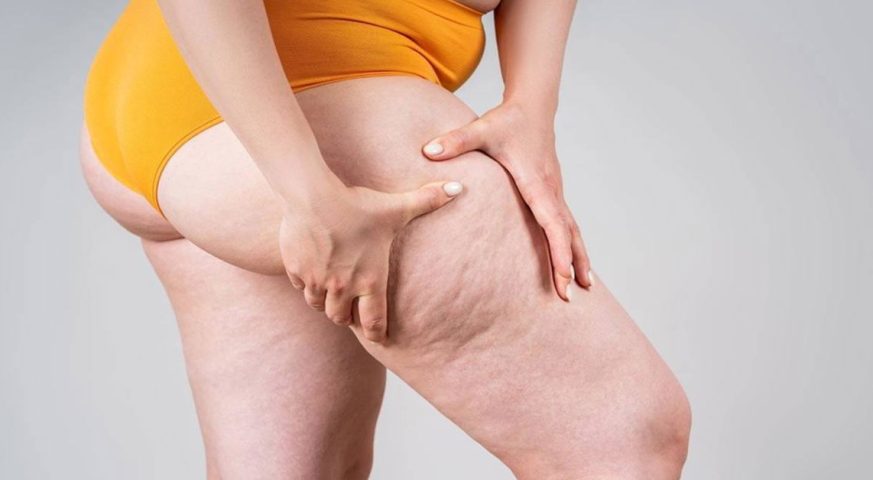 What is Lipedema Treatment?